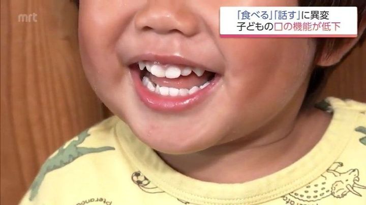 子の口腔機能発達不全症が増 背景
